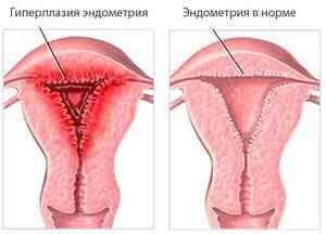 Что это - гиперплазия эндометрия, ее симптомы и лечение