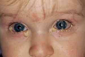 Желтые и белые выделения из глаз у ребенка, новорожденного грудничка
