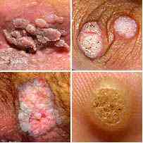 Инфекция,вызванная папилломавирусом человека(ВПЧ) - Папилломавирус ...