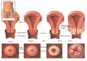 Удаление матки при миоме: последствия после операции